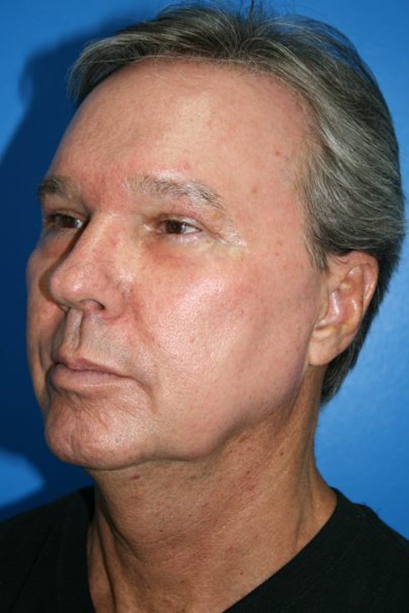 Eyelid Lift Before & After Gallery - Patient 187263 - Image 4