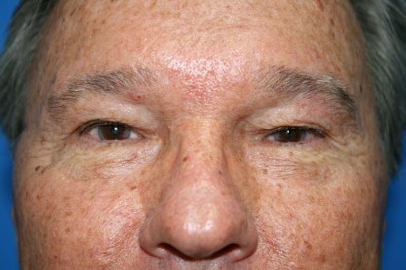 Eyelid Lift Before & After Gallery - Patient 187263 - Image 5