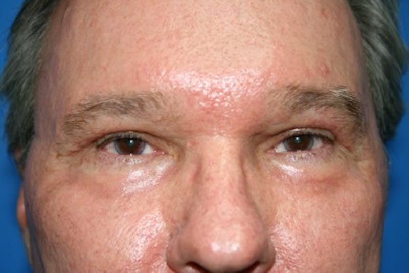 Eyelid Lift Before & After Gallery - Patient 187263 - Image 6