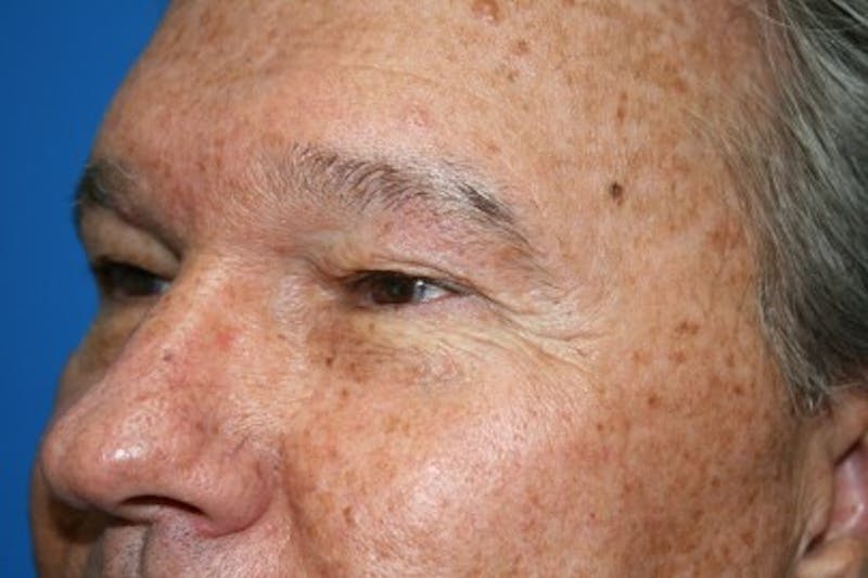 Eyelid Lift Before & After Gallery - Patient 187263 - Image 7