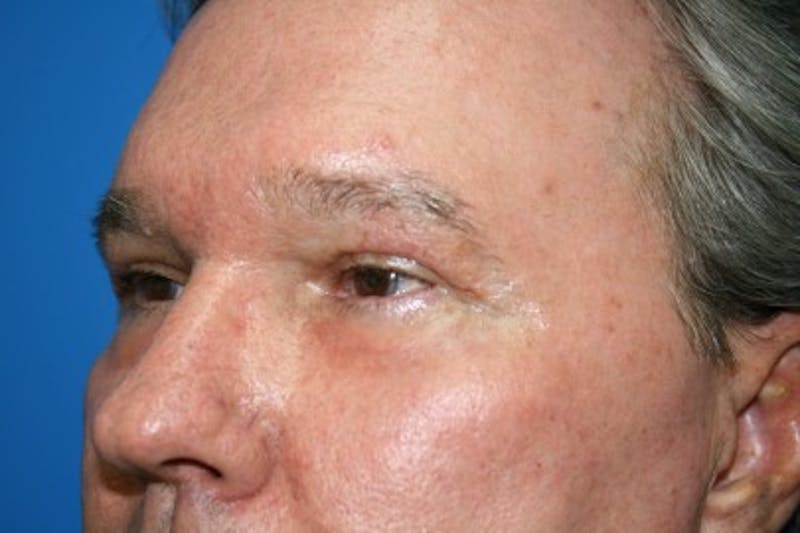 Eyelid Lift Before & After Gallery - Patient 187263 - Image 8