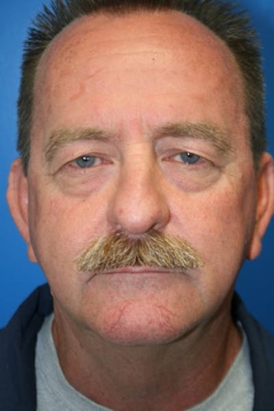 Eyelid Lift Before & After Gallery - Patient 428319 - Image 1