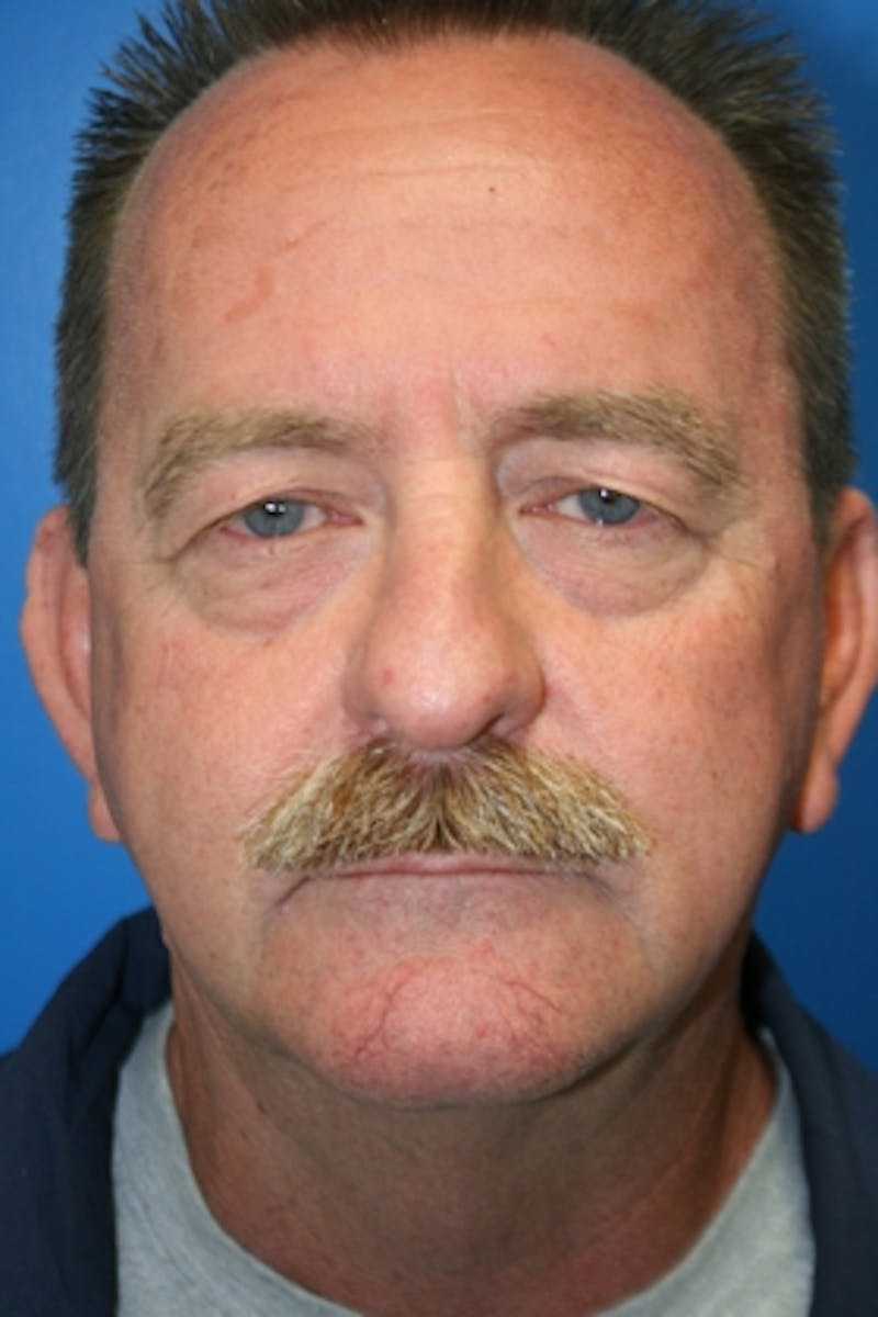 Eyelid Lift Before & After Gallery - Patient 428319 - Image 1