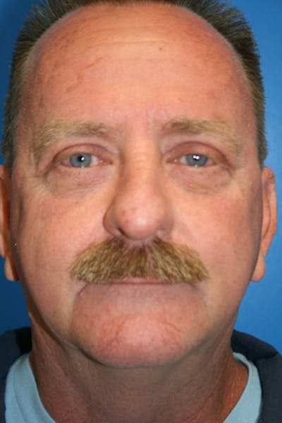 Eyelid Lift Before & After Gallery - Patient 428319 - Image 2