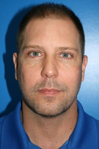 Eyelid Lift Before & After Gallery - Patient 403738 - Image 2