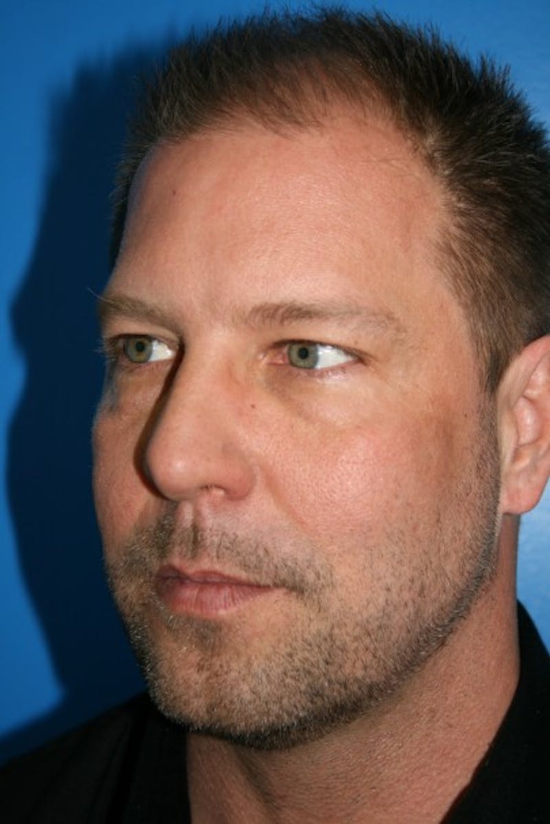 Eyelid Lift Before & After Gallery - Patient 403738 - Image 3