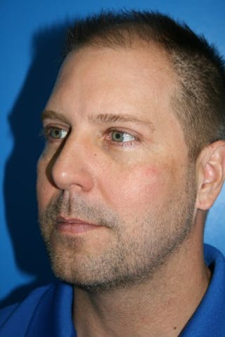 Eyelid Lift Before & After Gallery - Patient 403738 - Image 4