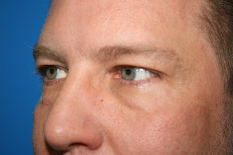 Eyelid Lift Before & After Gallery - Patient 403738 - Image 5