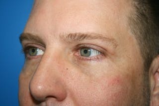 Eyelid Lift Before & After Gallery - Patient 403738 - Image 6