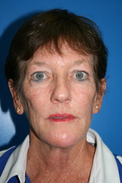 Eyelid Lift Before & After Gallery - Patient 110030 - Image 1