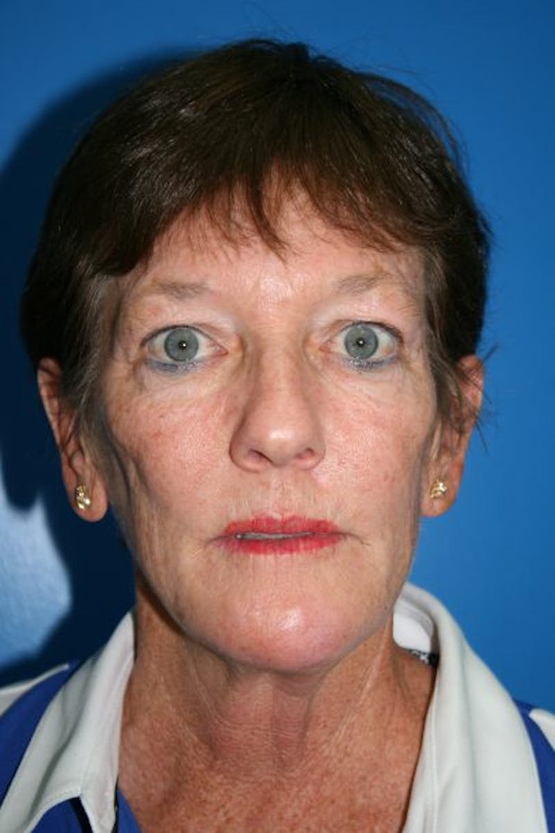 Eyelid Lift Before & After Gallery - Patient 110030 - Image 1