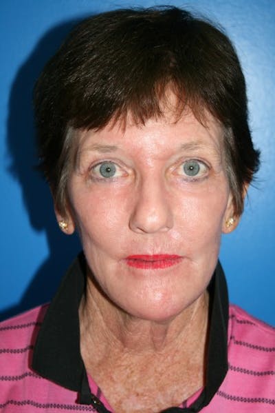 Eyelid Lift Before & After Gallery - Patient 110030 - Image 2