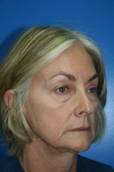 Eyelid Lift Before & After Gallery - Patient 245713 - Image 1