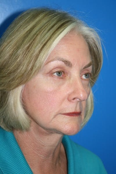 Eyelid Lift Before & After Gallery - Patient 245713 - Image 2