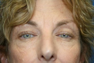 Eyelid Lift Before & After Gallery - Patient 344154 - Image 1