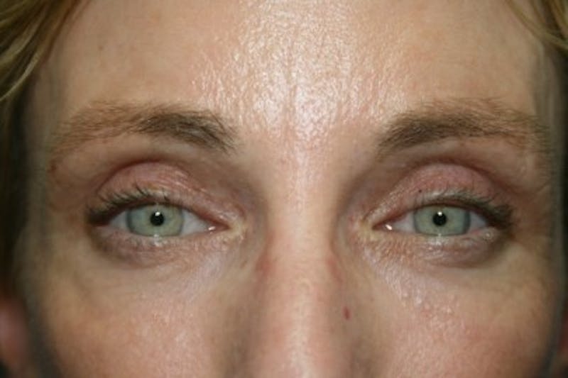 Eyelid Lift Before & After Gallery - Patient 344154 - Image 2