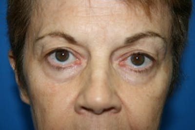 Eyelid Lift Before & After Gallery - Patient 140982 - Image 1