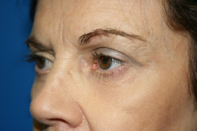 Eyelid Lift Before & After Gallery - Patient 140982 - Image 4