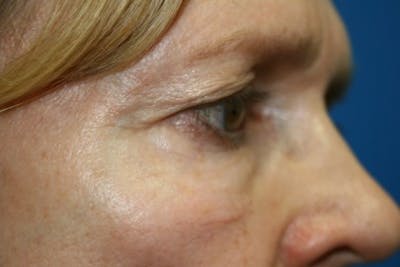 Eyelid Lift Before & After Gallery - Patient 270132 - Image 1