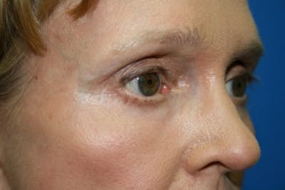 Eyelid Lift Before & After Gallery - Patient 270132 - Image 2