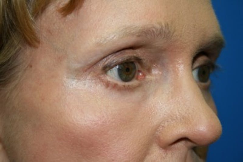 Eyelid Lift Before & After Gallery - Patient 270132 - Image 2