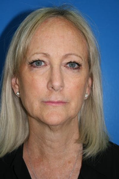 Eyelid Lift Before & After Gallery - Patient 408990 - Image 1