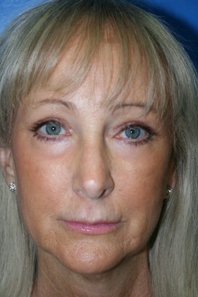 Eyelid Lift Before & After Gallery - Patient 408990 - Image 2