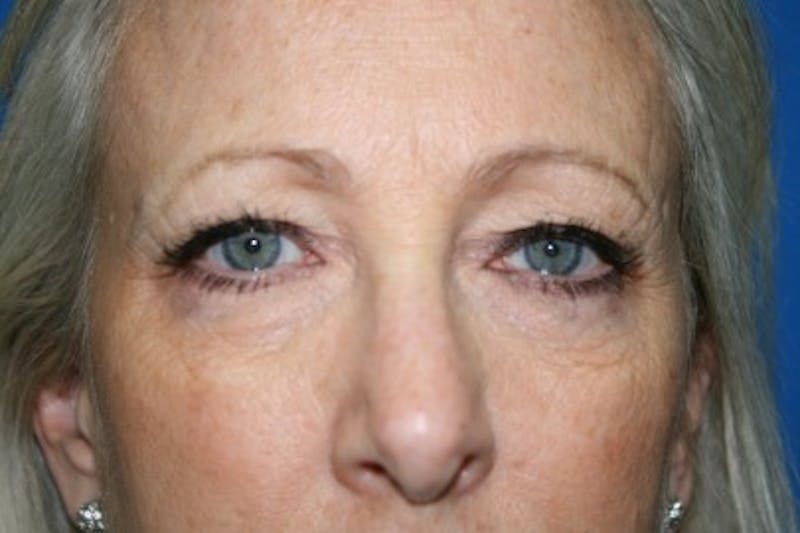 Eyelid Lift Before & After Gallery - Patient 408990 - Image 3