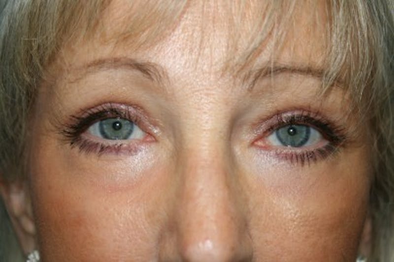 Eyelid Lift Before & After Gallery - Patient 408990 - Image 4