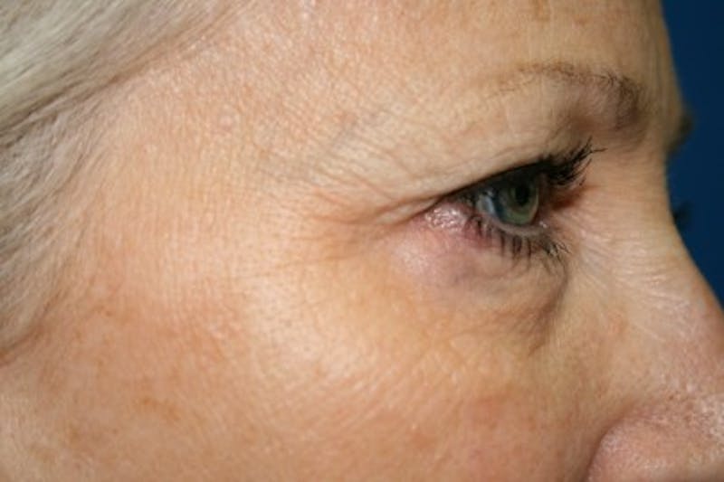 Eyelid Lift Before & After Gallery - Patient 408990 - Image 5