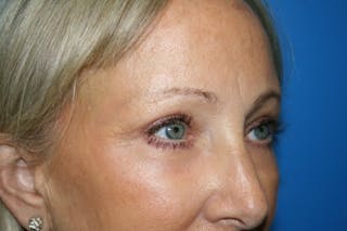 Eyelid Lift Before & After Gallery - Patient 408990 - Image 6