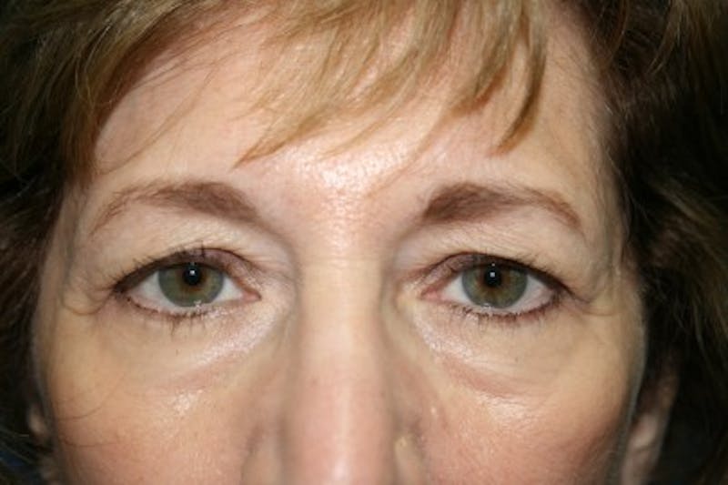Eyelid Lift Before & After Gallery - Patient 366856 - Image 1