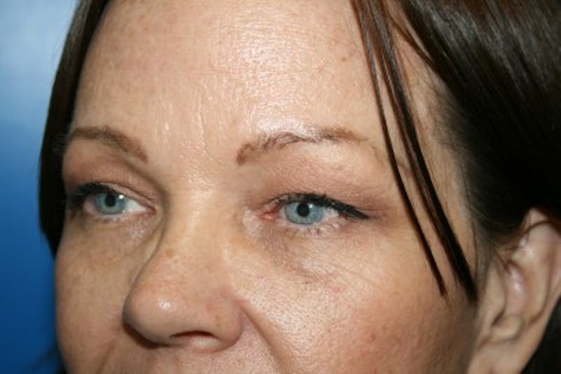 Eyelid Lift Before & After Gallery - Patient 152665 - Image 1