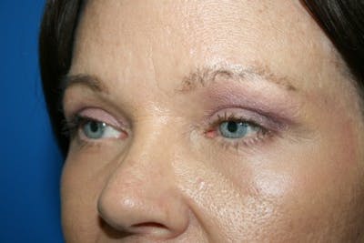 Eyelid Lift Before & After Gallery - Patient 152665 - Image 2