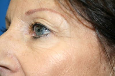 Eyelid Lift Before & After Gallery - Patient 104559 - Image 1