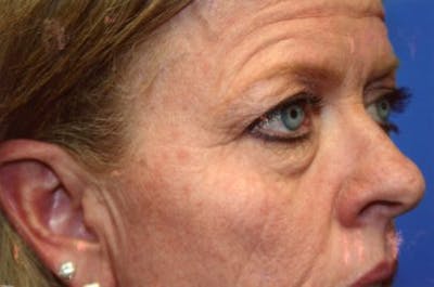 Eyelid Lift Before & After Gallery - Patient 443907 - Image 1