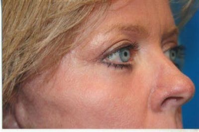 Eyelid Lift Before & After Gallery - Patient 443907 - Image 2