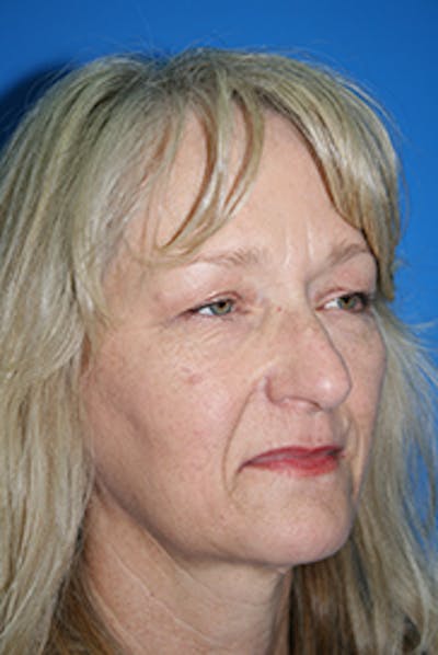 Eyelid Lift Before & After Gallery - Patient 374839 - Image 1
