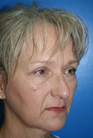 Eyelid Lift Before & After Gallery - Patient 374839 - Image 2