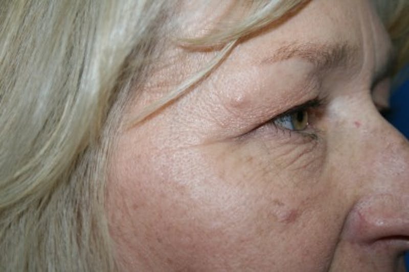 Eyelid Lift Before & After Gallery - Patient 374839 - Image 3