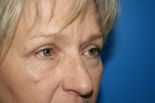Eyelid Lift Before & After Gallery - Patient 374839 - Image 4