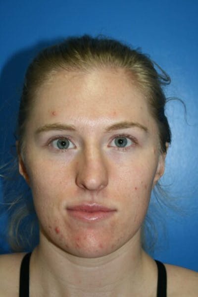 Rhinoplasty Before & After Gallery - Patient 409731 - Image 1