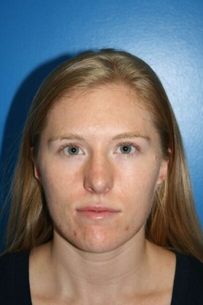 Rhinoplasty Before & After Gallery - Patient 409731 - Image 2