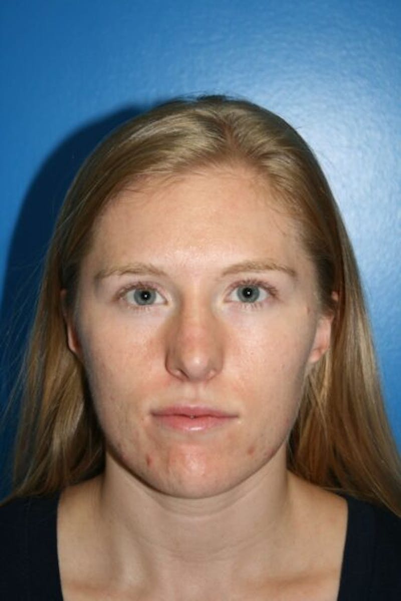 Rhinoplasty Before & After Gallery - Patient 409731 - Image 2