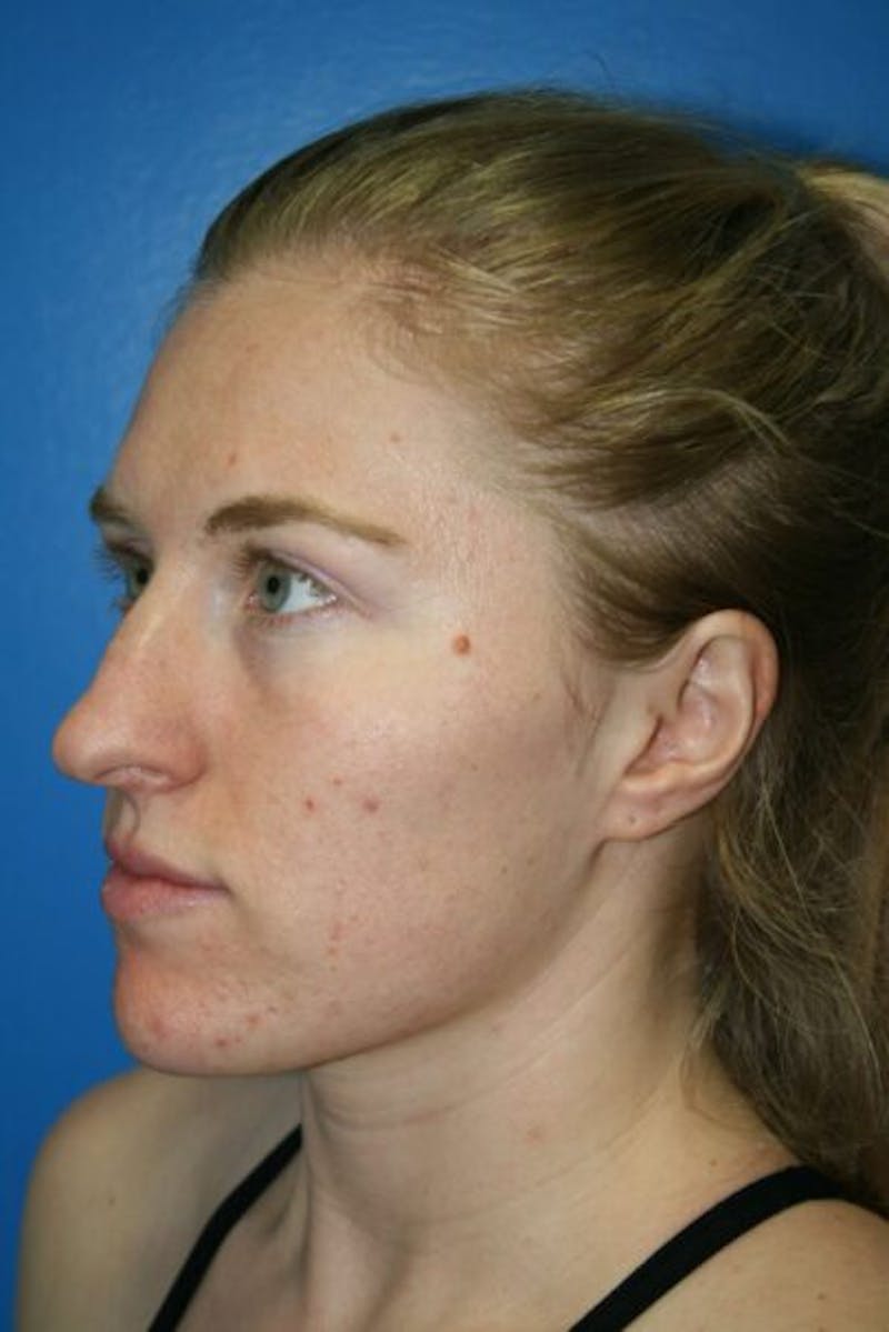 Rhinoplasty Before & After Gallery - Patient 409731 - Image 3