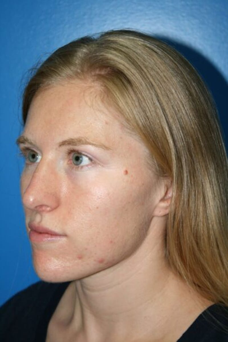 Rhinoplasty Before & After Gallery - Patient 409731 - Image 4