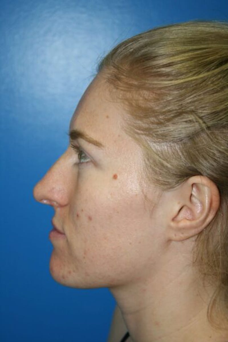 Rhinoplasty Before & After Gallery - Patient 409731 - Image 5