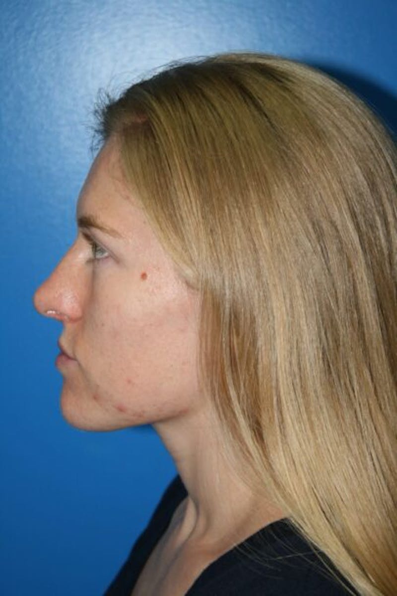 Rhinoplasty Before & After Gallery - Patient 409731 - Image 6