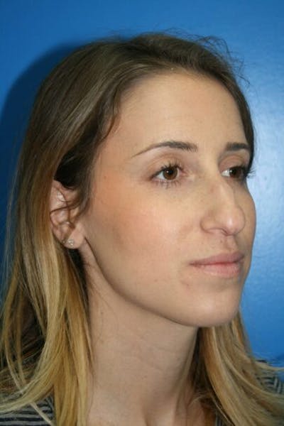 Rhinoplasty Before & After Gallery - Patient 428725 - Image 1