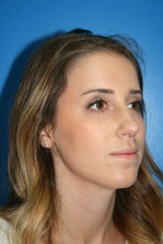 Rhinoplasty Before & After Gallery - Patient 428725 - Image 2